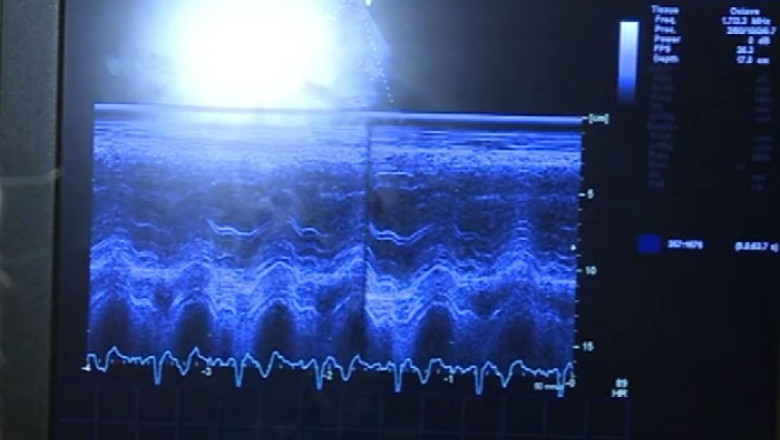 70% dintre pacientii cu infarct au sub 45 de ani. Care sunt simptomele Imagine