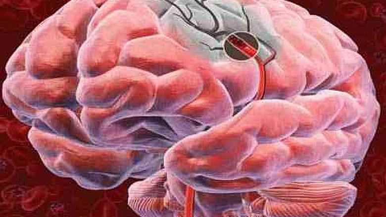 Accidentele vasculare cerebrale, tot mai frecvente in randul tinerilor. Cum recunoastem simptomele unui AVC Imagine