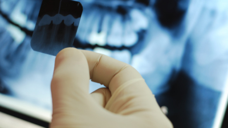 Afectiune genetica rara in stomatologie. Cum poate fi depistata Imagine