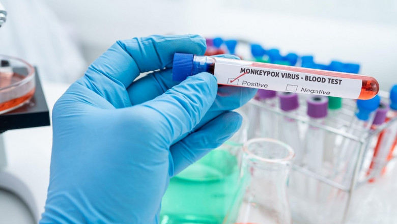 Al doilea caz de variola maimutei diagnosticat in Romania Imagine