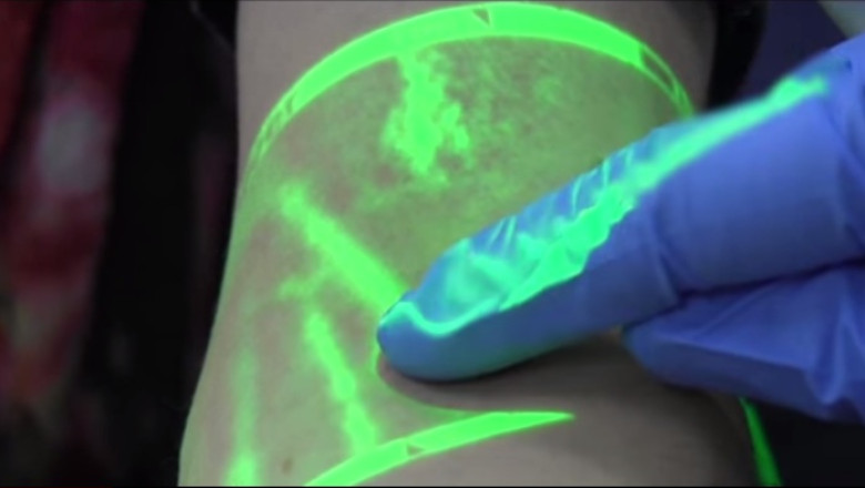 Aparatul care face sa dispara teama de ac. Cele mai ascunse vene devin vizibile Imagine