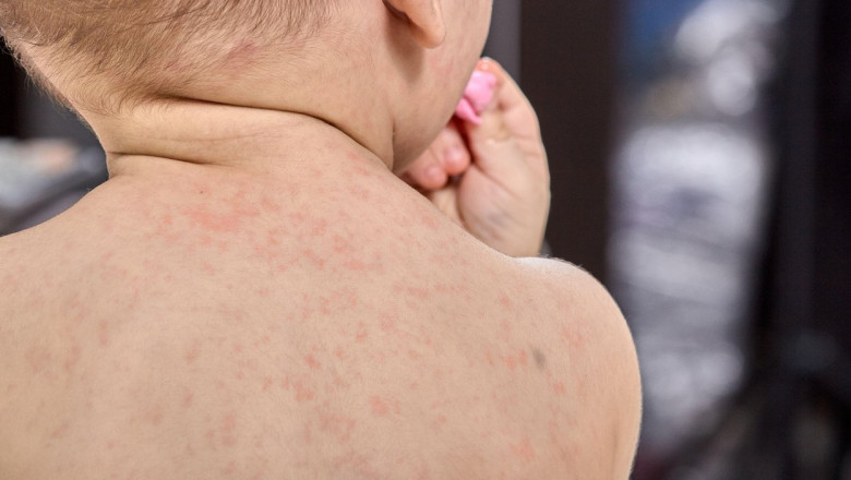 Aproape 800 de cazuri noi de rujeola au fost inregistrate in ultima saptamana. Un copil in varsta de 1 an a murit Imagine