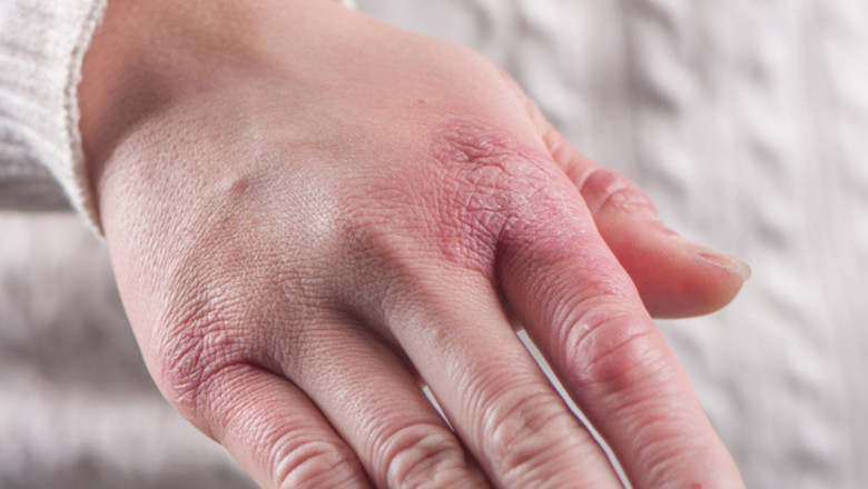 Asculta-ti corpul: cum sa-ti protejezi pielea de efectele frigului, 5 recomandari esentiale pentru sezonul rece Imagine