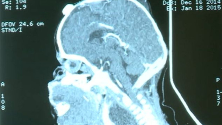 Bebelus scapat de o tumora de un kilogram. O fetita de o luna a fost operata la Spitalul „Marie Curie” Imagine