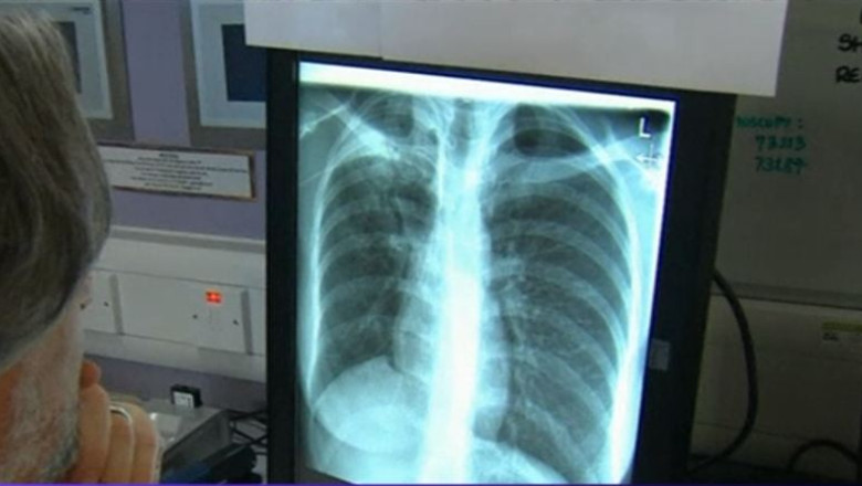 Bolnavii de TBC, sabotati de birocratie. Romania risca sa piarda 10 milioane de euro pentru ca Finantele nu acorda Sanatatii 10.000 de lei Imagine