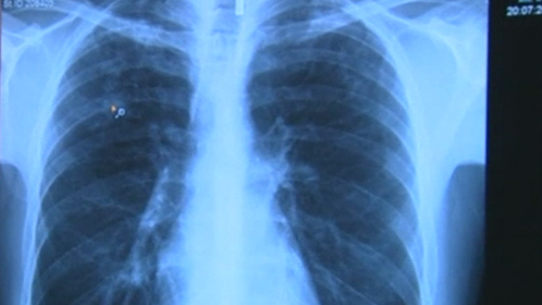 Bucuresti, capitala europeana a tuberculozei Imagine