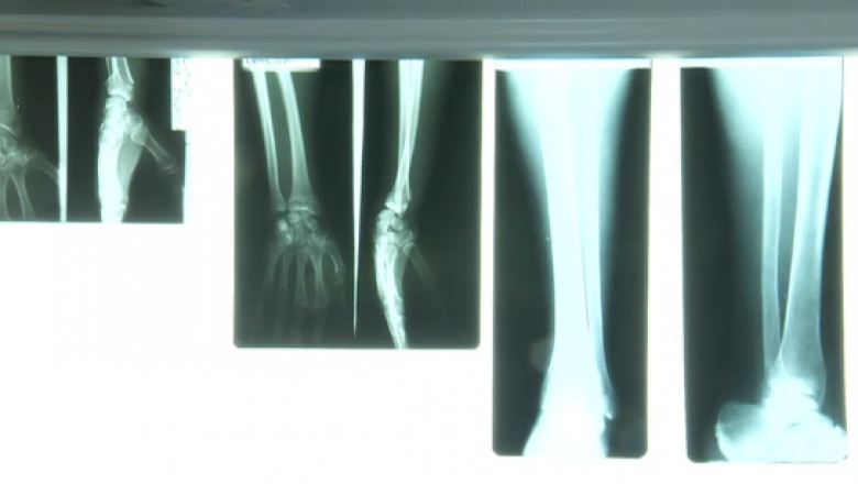 Caz revoltator la Alba Iulia. Medicii au trimis acasa un copil de 5 ani cu mana rupta si i-au recomandat doar un unguent Imagine