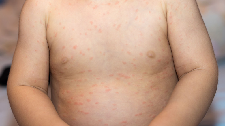 Ce inseamna declararea epidemiei de rujeola in Romania. Care sunt simptomele bolii si ce complicatii apar Imagine