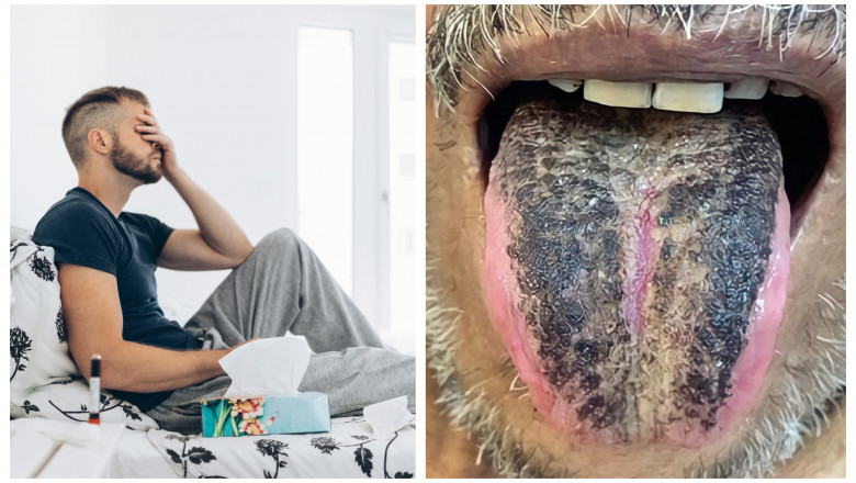 Cele mai fascinante cazuri medicale din 2022: Barbatul cu alergie la orgasme si cel caruia dieta i-a facut limba neagra si paroasa Imagine
