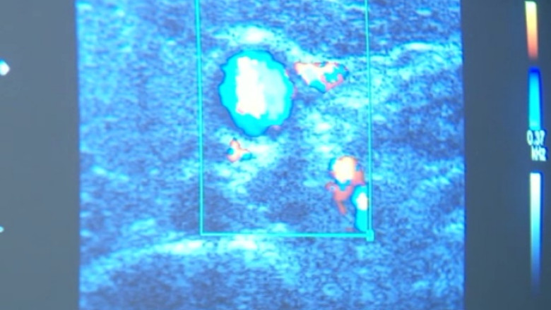 Consumul de sare si fumatul cresc riscul aparitiei cancerului gastric Imagine