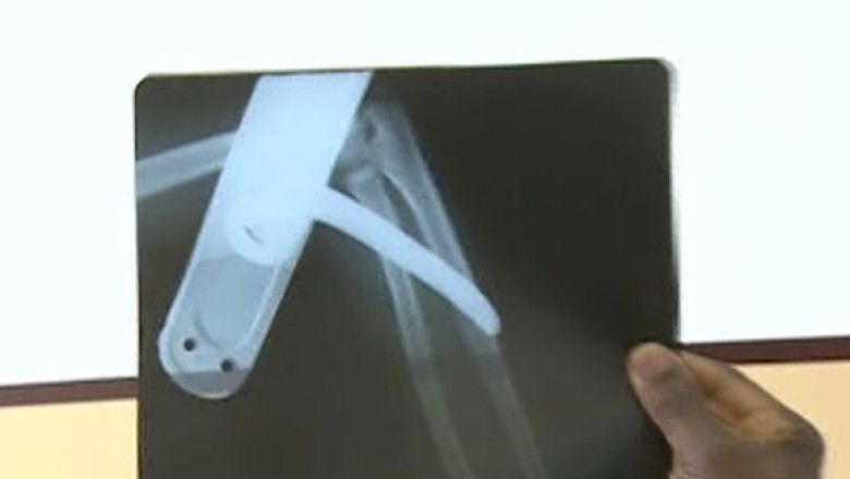 Copil cu clanta infipta in brat Imagine