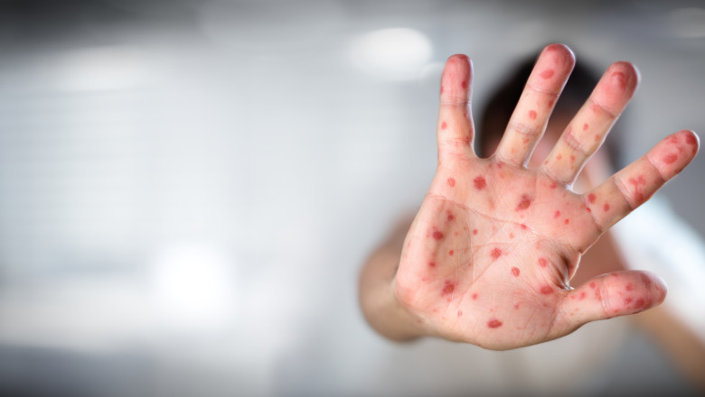 Copil de 2 ani diagnosticat cu tuse convulsiva si rujeola. Copilul nu a facut niciun vaccin de cand s-a nascut Imagine
