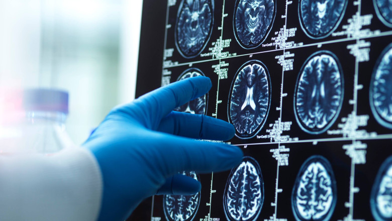 Creierul barbatilor se micsoreaza mai repede decat cel al femeilor pe masura ce imbatranesc, arata un studiu Imagine