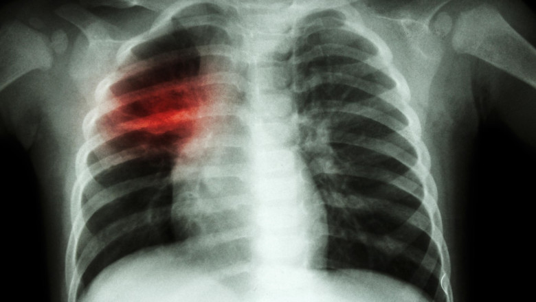 Crestere alarmanta a cazurilor de tuberculoza la copii in Europa si Asia Centrala. OMS cere masuri imediate Imagine