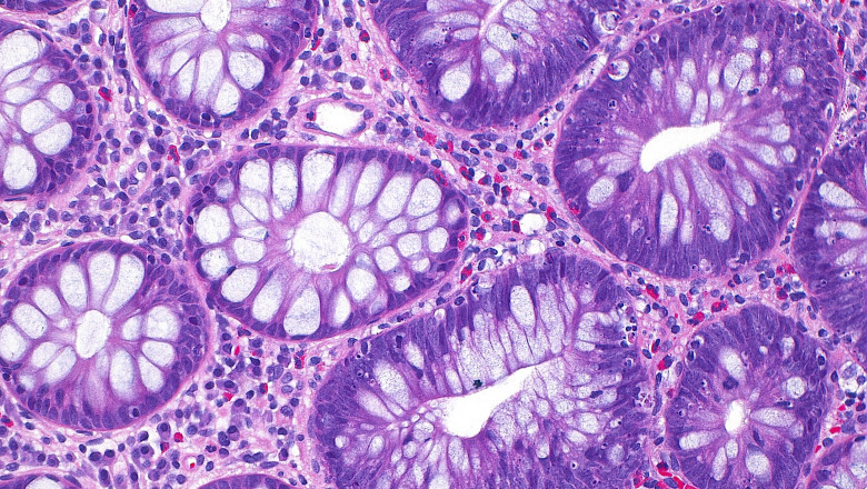 Cum a ajuns cancerul de colon sa afecteze tot mai multi tineri si care este cauza principala, indicata de studii Imagine