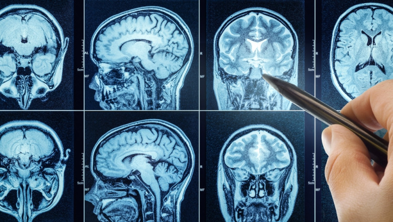 Cum ar putea inteligenta artificiala sa revolutioneze diagnosticarea tumorilor pe creier (studiu) Imagine