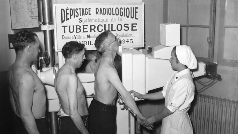 Cum au ajutat tigarile, ciocolata si pizza la combaterea unei epidemii de tuberculoza (BBC) Imagine