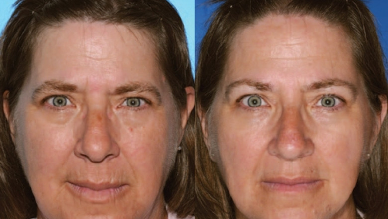 Efectele fumatului: Pielea imbatraneste prematur si prezinta mai multe riduri. Un nou studiu a fost realizat pe perechi de gemeni Imagine