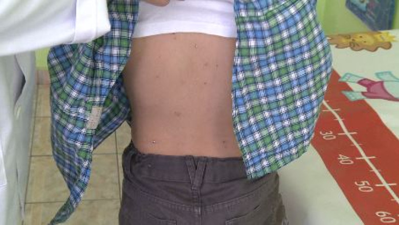 Epidemie de varicela la Cluj-Napoca. Cei mai afectati sunt copiii cu varste cuprinse intre 2 si 10 ani Imagine