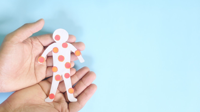 Focar de rujeola in Israel. Numarul cazurilor a ajuns la 48, majoritatea fiind copii nevaccinati Imagine