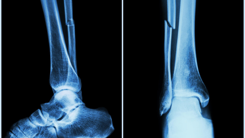 Fracturi vindecate in cateva minute: un lipici pentru oase, solutia gasita de cercetatorii chinezi Imagine