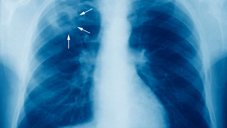 Harta neagra a incidentei cazurilor de tuberculoza. Familii intregi se imbolnavesc, iar aparatura moderna sta in cutii, sub cheie Imagine