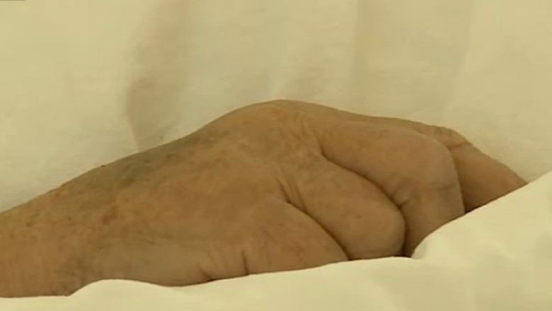 Hepatita A, din ce in ce mai agresiva. Romania inregistreaza de patru ori mai multe imbolnaviri decat restul tarilor UE Imagine