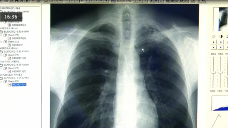 IASI. Numarul persoanelor diagnosticate cu cancer pulmonar este in crestere  Imagine