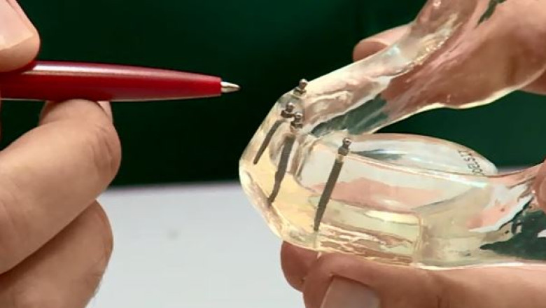 Implant dentar revolutionar Imagine