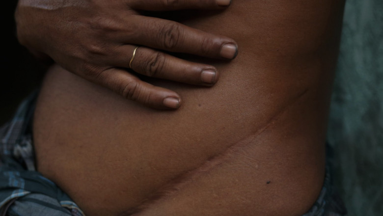 In „Valea Rinichilor” aproape fiecare nepalez si-a vandut un rinichi din cauza saraciei. Li s-a spus ca le creste la loc Imagine