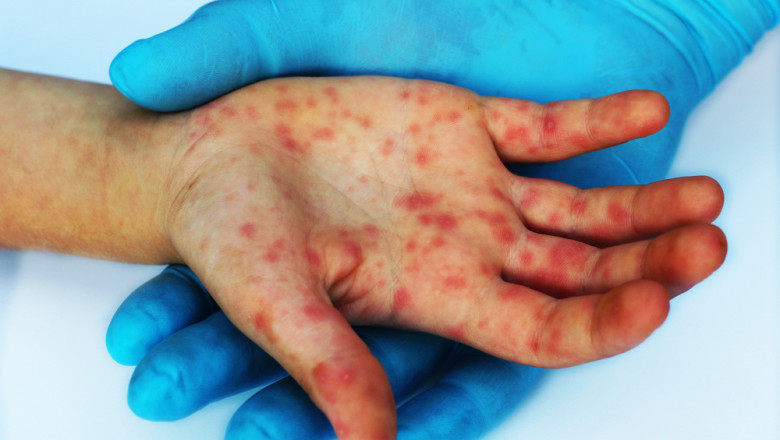 Inca doi morti din cauza rujeolei: Un bebelus de 7 luni din Brasov care inca nu putea fi vaccinat si un adult din Bucuresti, nevaccinat Imagine