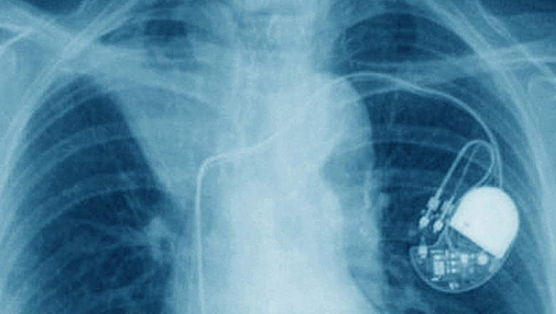 Medic din Iasi, acuzat ca a montat aproape 240 de stimulatoare cardiace luate de la cadavre. Cum isi convingea pacientii Imagine