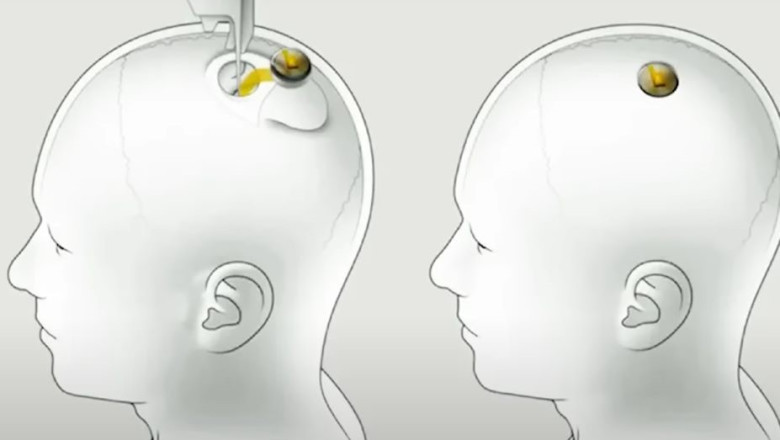 Mii de oameni vor un implant cerebral dezvoltat de compania lui Elon Musk, dar Neuralink nu gaseste primul om care sa fie testat Imagine
