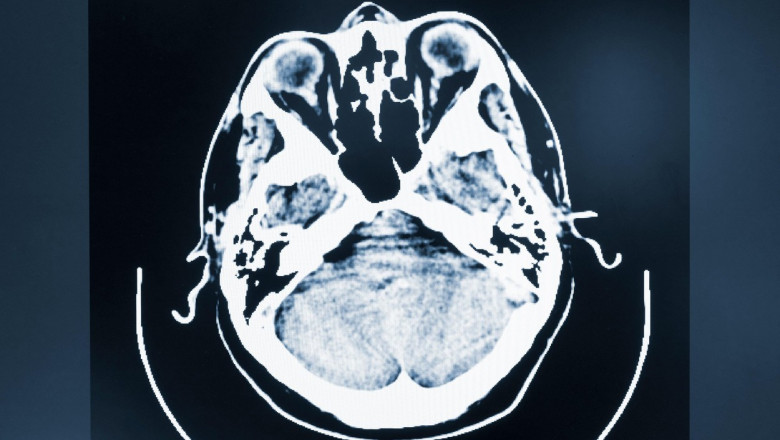 Neuralink, compania lui Elon Musk, cauta voluntari pentru a incepe testele cu implanturi cerebrale pe oameni Imagine