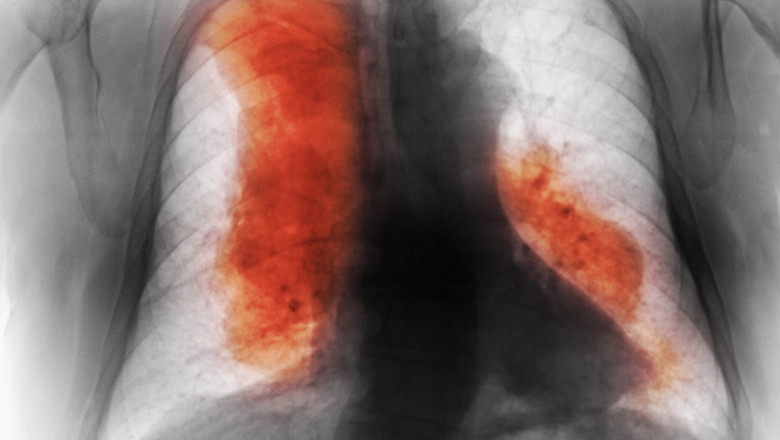Numarul deceselor cauzate de cancer ar urma sa creasca semnificativ pana in 2050. Cele mai frecvente si cele mai mortale (studiu) Imagine