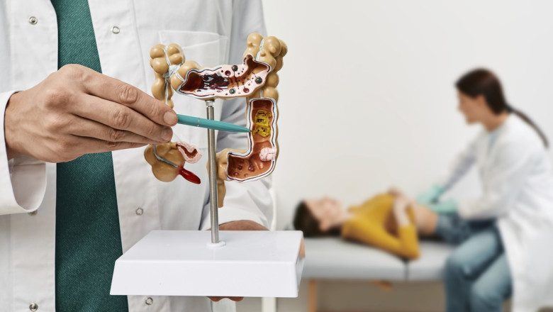 O proteina a sistemului imunitar poate combate cancerul intestinal in stadii incipiente Imagine