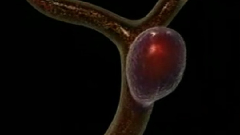 Operatia pe carotida poate preveni accidentul vascular cerebral Imagine