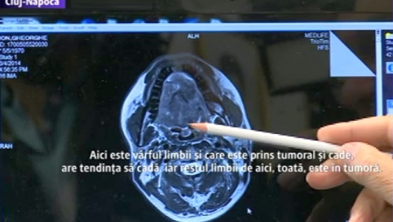 Operatie-comando la Cluj: Medicii au extirpat limba si laringele unui barbat bolnav de cancer Imagine