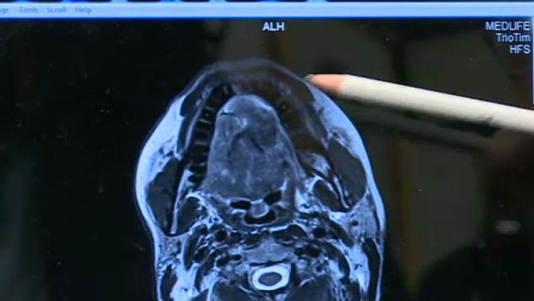 Operatie riscanta la Cluj. Medicii au extirpat limba unui pacient si au reconstruit-o din muschii pectorali Imagine