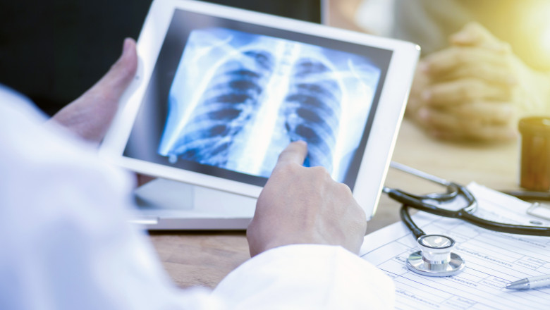 „Pacientii nu isi recunosc simptomele”. Tuberculoza face mii de victime in Romania, insa putini dintre bolnavi ajung la timp la medic Imagine