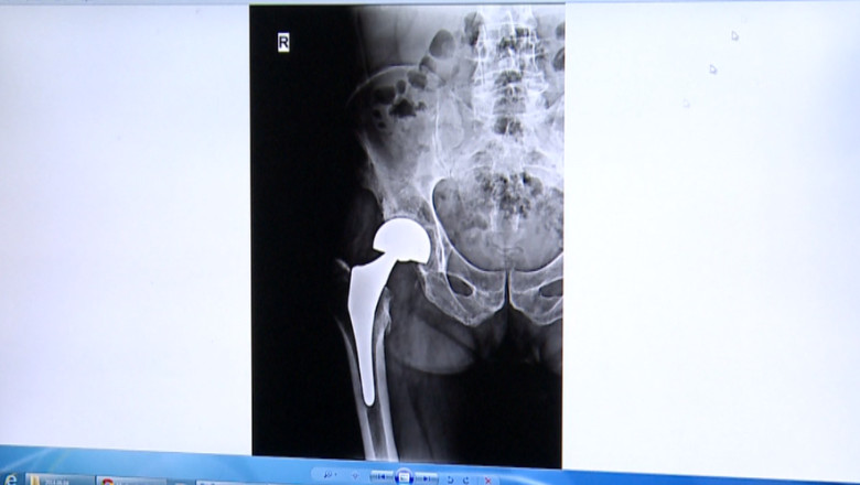 Pe lista de asteptare pentru a putea merge. Peste 150 de pacienti din Iasi au nevoie de proteze ortopedice Imagine