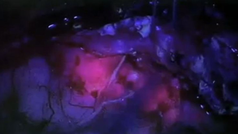 Premiera in Romania. Substanta fluorescenta folosita intr-o operatie pe creier Imagine