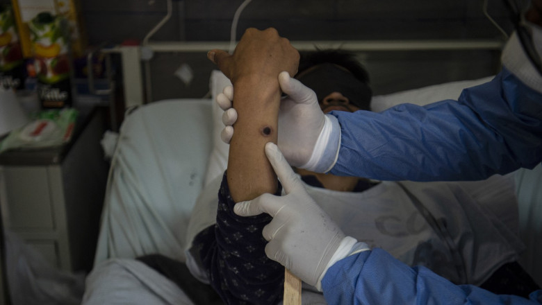 Primul caz de variola maimutei in Europa. Avertismentul dr. Adrian Marinescu: Noua tulpina mpox poate pune probleme Imagine