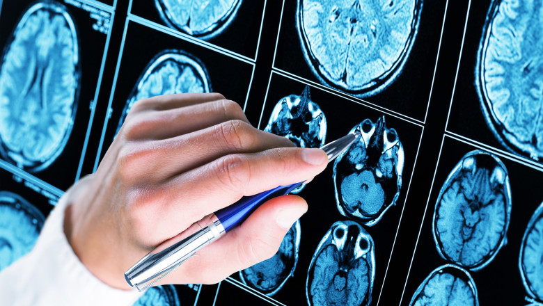 Primul dispozitiv din lume care controleaza crizele de epilepsie a fost montat in craniul unui baiat din Anglia. Cum functioneaza Imagine
