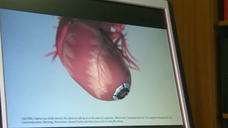 Primul implant de inima artificiala din Romania, un succes. Medicii spera la un program national Imagine