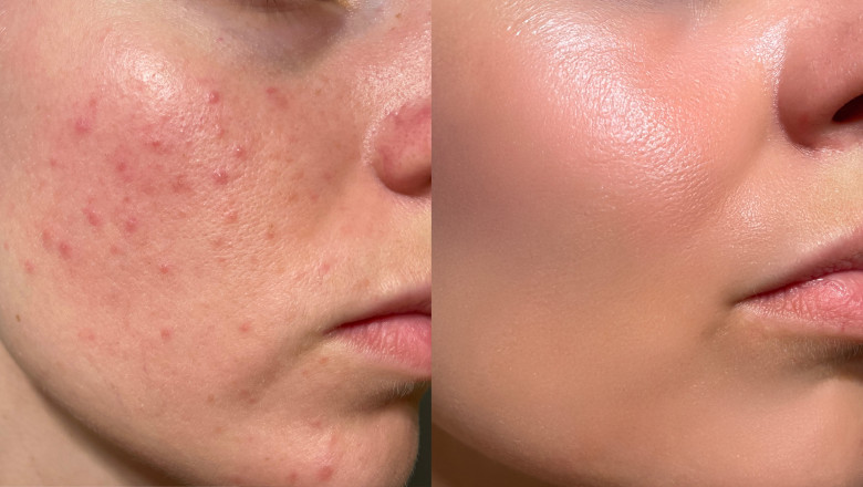 Primul vaccin impotriva acneei moderate si severe, in faza de testare clinica. In cat timp ar putea ajunge la pacienti Imagine