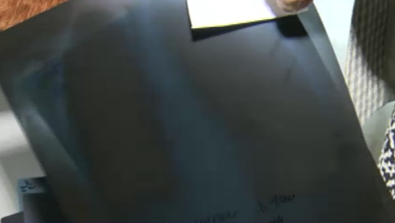 Radiografii incurcate la spital. Un copil cu mana rupta, diagnosticat cu afectiune craniana Imagine