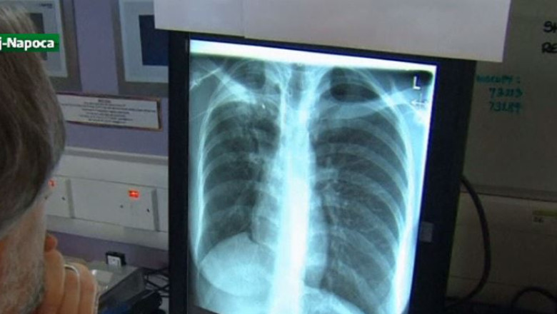 Record medical la Cluj. Medicii au extirpat 327 de tumori dintr-un singur plaman Imagine