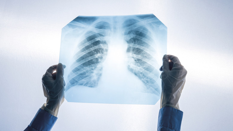 Screeningul pulmonar, o investigatie esentiala pentru fumatorii cu varsta de peste 50 de ani Imagine