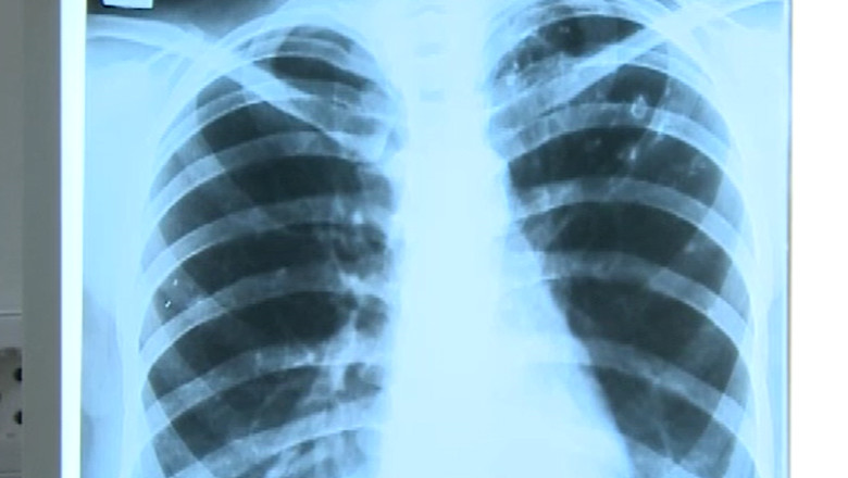 Semnal de alarma din partea medicilor pneumologi: bolnavii de TBC, un „pericol public”  Imagine